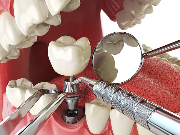 Best Lost Filling or Crown Replacement in Half Moon, NC